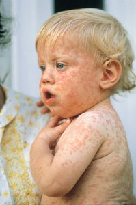 A child with measles, seen in this photograph, shows the characteristic pink rash that spreads all over the body. Measles occurs chiefly in children, but some young adults also catch it. Credit: © Lowell Georgia, Photo Researchers 